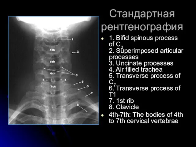 Стандартная рентгенография 1. Bifid spinous process of C3 2. Superimposed articular