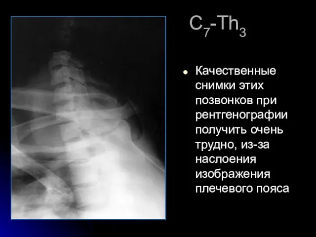 С7-Th3 Качественные снимки этих позвонков при рентгенографии получить очень трудно, из-за наслоения изображения плечевого пояса