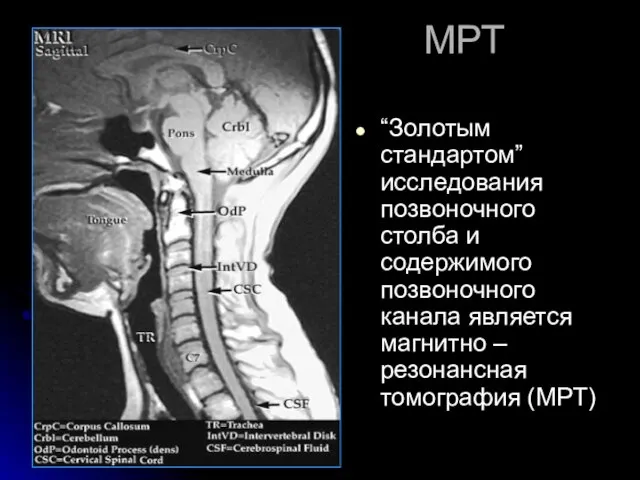 МРТ “Золотым стандартом” исследования позвоночного столба и содержимого позвоночного канала является магнитно – резонансная томография (МРТ)