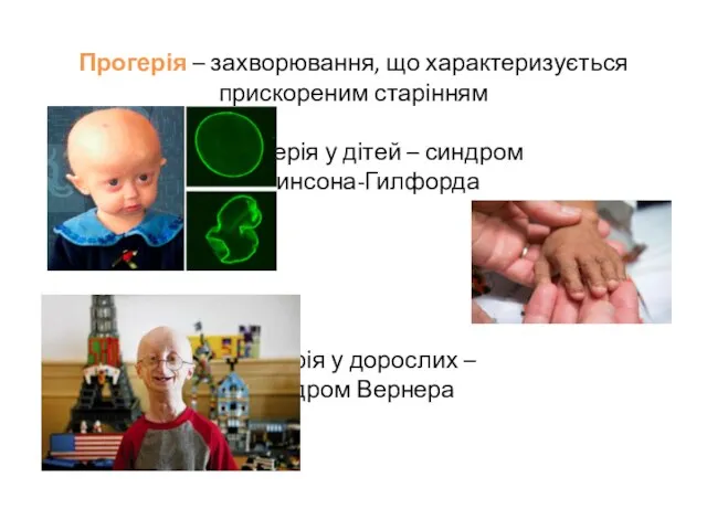 Прогерія – захворювання, що характеризується прискореним старінням прогерія у дітей –