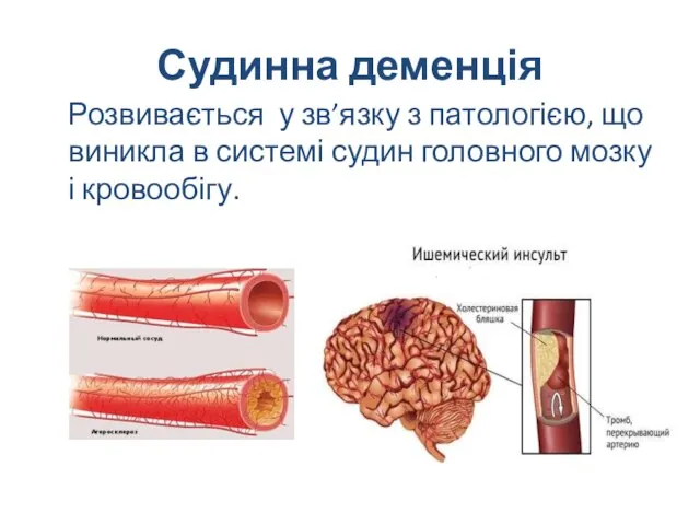 Судинна деменція Розвивається у зв’язку з патологією, що виникла в системі судин головного мозку і кровообігу.