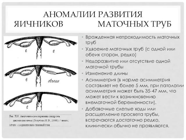 АНОМАЛИИ РАЗВИТИЯ ЯИЧНИКОВ МАТОЧНЫХ ТРУБ Врожденная непроходимость маточных труб Удвоение маточных