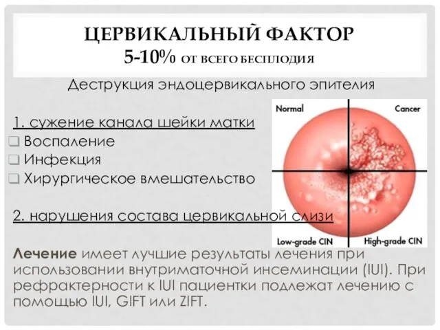 ЦЕРВИКАЛЬНЫЙ ФАКТОР 5-10% ОТ ВСЕГО БЕСПЛОДИЯ Деструкция эндоцервикального эпителия 1. сужение