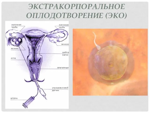 ЭКСТРАКОРПОРАЛЬНОЕ ОПЛОДОТВОРЕНИЕ (ЭКО)