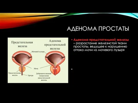 АДЕНОМА ПРОСТАТЫ Аденома предстательной железы – разрастание железистой ткани простаты, ведущее