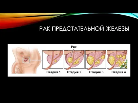 РАК ПРЕДСТАТЕЛЬНОЙ ЖЕЛЕЗЫ