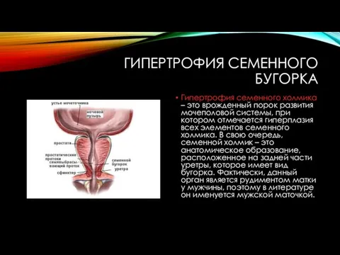 ГИПЕРТРОФИЯ СЕМЕННОГО БУГОРКА Гипертрофия семенного холмика – это врожденный порок развития