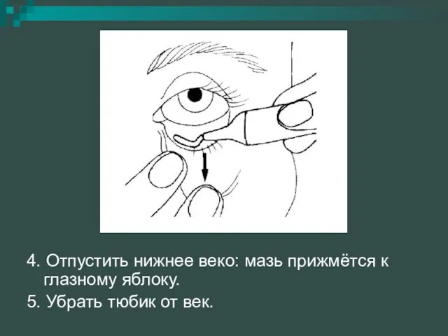 4. Отпустить нижнее веко: мазь прижмётся к глазному яблоку. 5. Убрать тюбик от век.