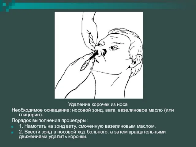 Удаление корочек из носа Необходимое оснащение: носовой зонд, вата, вазелиновое масло