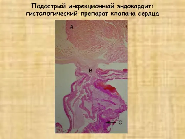 Подострый инфекционный эндокардит: гистологический препарат клапана сердца