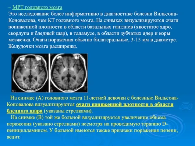 – МРТ головного мозга Это исследование более информативно в диагностике болезни