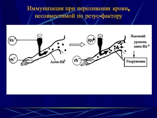 Иммунизация при переливании крови, несовместимой по резус-фактору