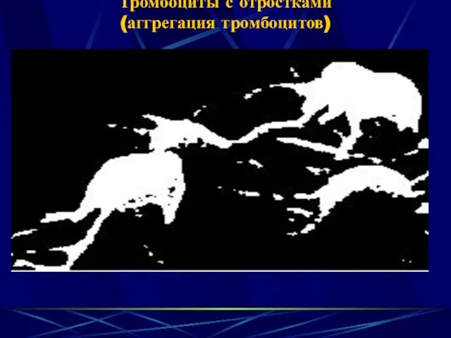 Тромбоциты с отростками (аггрегация тромбоцитов)