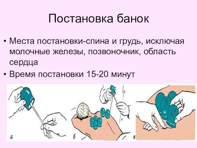 Постановка банок Места постановки-спина и грудь, исключая молочные железы, позвоночник, область сердца Время постановки 15-20 минут