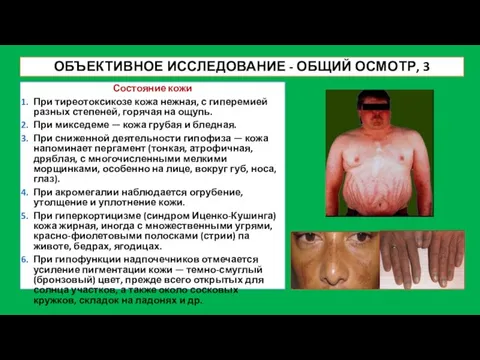 ОБЪЕКТИВНОЕ ИССЛЕДОВАНИЕ - ОБЩИЙ ОСМОТР, 3 Состояние кожи При тиреотоксикозе кожа