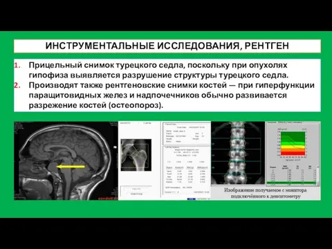 ИНСТРУМЕНТАЛЬНЫЕ ИССЛЕДОВАНИЯ, РЕНТГЕН Прицельный снимок турецкого седла, поскольку при опухолях гипофиза