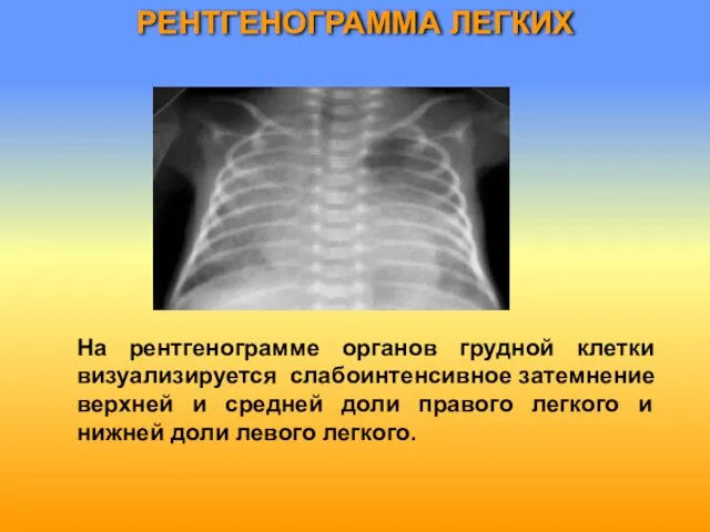 РЕНТГЕНОГРАММА ЛЕГКИХ На рентгенограмме органов грудной клетки визуализируется слабоинтенсивное затемнение верхней