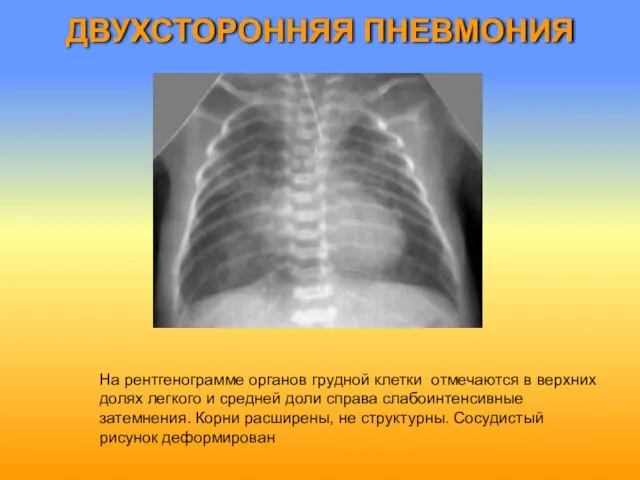 ДВУХСТОРОННЯЯ ПНЕВМОНИЯ На рентгенограмме органов грудной клетки отмечаются в верхних долях