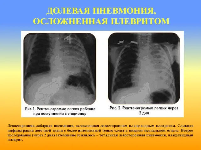 ДОЛЕВАЯ ПНЕВМОНИЯ, ОСЛОЖНЕННАЯ ПЛЕВРИТОМ Левосторонняя лобарная пневмония, осложненная левосторонним плащевидным плевритом.