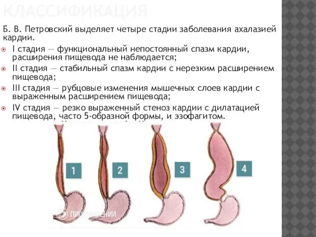 КЛАССИФИКАЦИЯ Б. В. Петров­ский выделяет четыре ста­дии заболевания ахалазией кардии. I