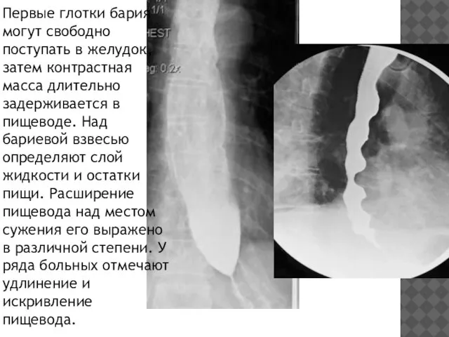 Первые глотки бария могут свободно поступать в желудок, затем контрастная масса