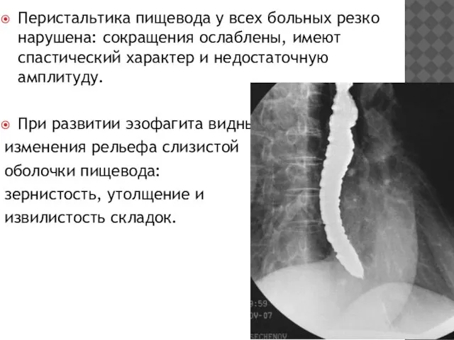 Перистальтика пищевода у всех больных резко нарушена: сокращения ослаблены, имеют спастический