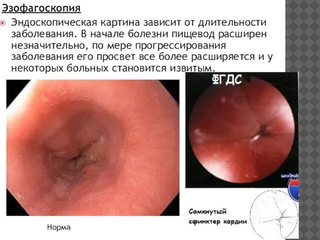 Эзофагоскопия Эндоскопическая картина зависит от длительности заболевания. В начале бо­лезни пищевод