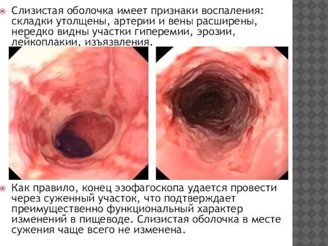 Слизистая оболочка имеет признаки вос­паления: складки утолщены, артерии и вены расширены,