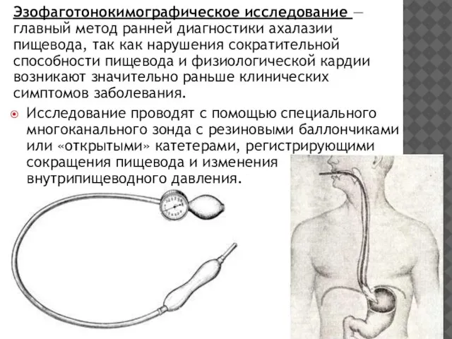 Эзофаготонокимографическое исследование — главный метод ранней диагностики ахалазии пищевода, так как