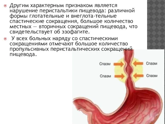 Другим характерным признаком является нарушение пе­ристальтики пищевода: различной формы глотательные и