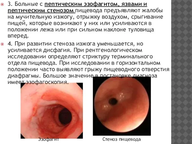 Стеноз пищевода 3. Больные с пептическим эзофагитом, язвами и пептическим сте­нозом