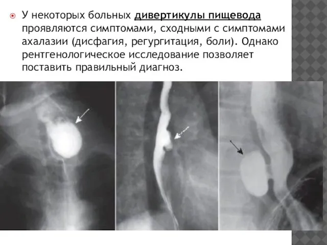 У некоторых больных дивертикулы пищевода проявляются симп­томами, сходными с симптомами ахалазии