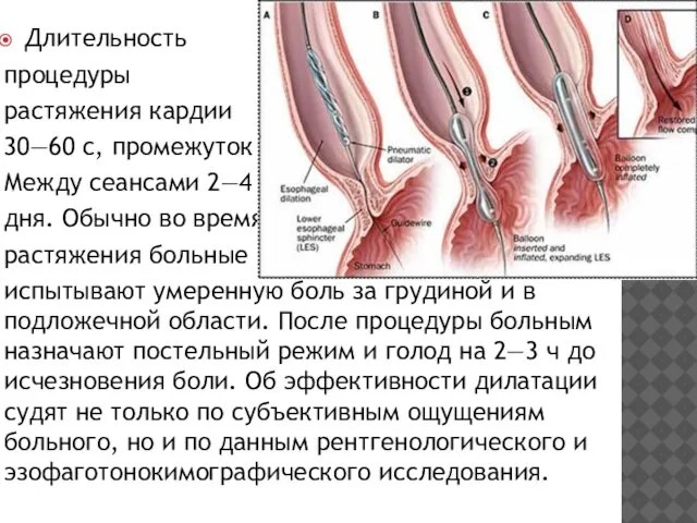 Длитель­ность процедуры растяжения кардии 30—60 с, промежуток Между сеансами 2—4 дня.