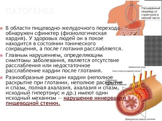 ПАТОГЕНЕЗ В области пищеводно-желудочного перехода обнаружен сфинктер (физиологическая кардия). У здоровых