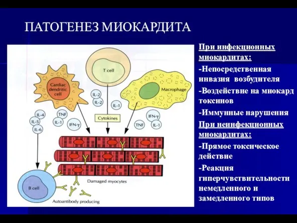 ПАТОГЕНЕЗ МИОКАРДИТА При инфекционных миокардитах: -Непосредственная инвазия возбудителя -Воздействие на миокард