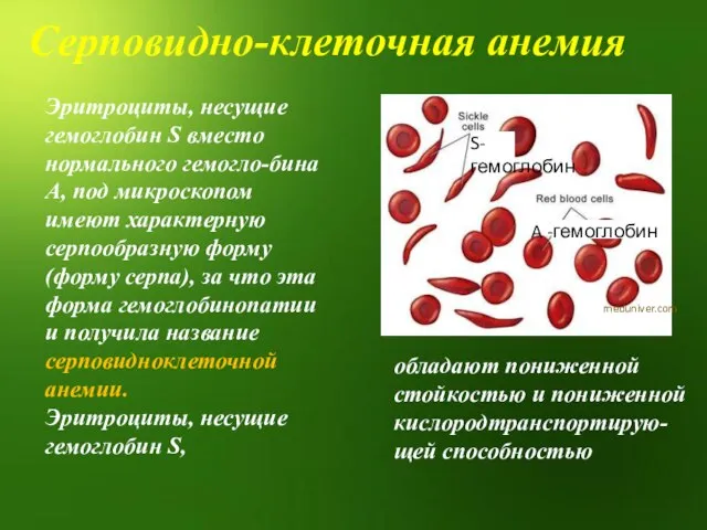 Серповидно-клеточная анемия Эритроциты, несущие гемоглобин S вместо нормального гемогло-бина А, под