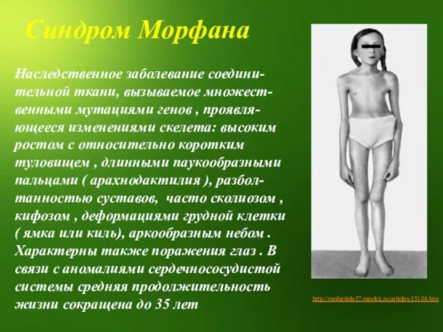 http://medarticle37.moslek.ru/articles/15184.htm Наследственное заболевание соедини-тельной ткани, вызываемое множест-венными мутациями генов , проявля-ющееся