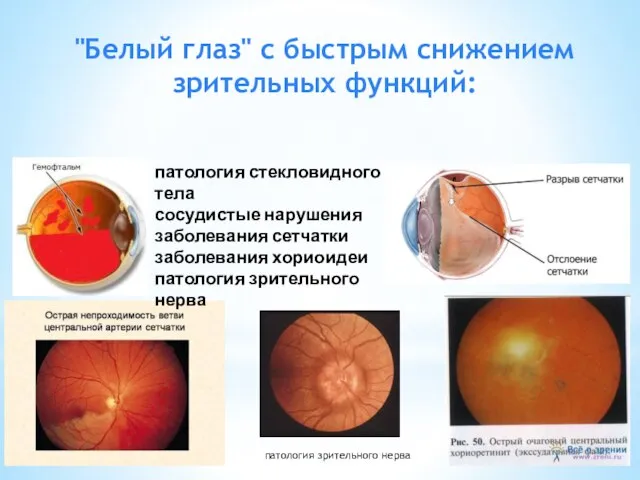 "Белый глаз" с быстрым снижением зрительных функ­ций: патология зрительного нерва патология