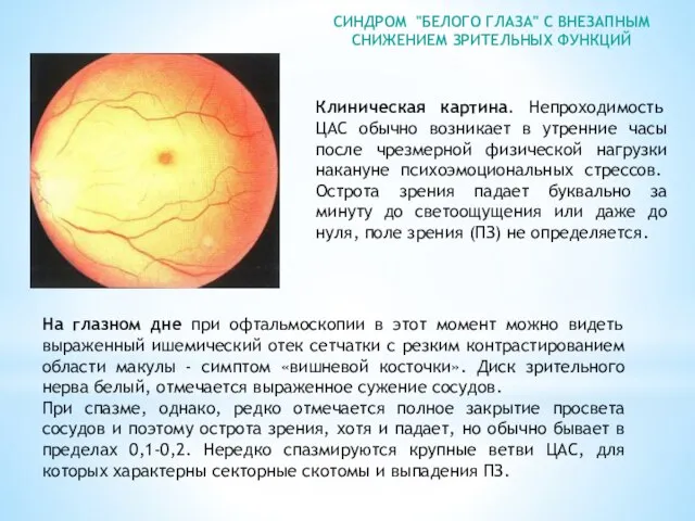 СИНДРОМ "БЕЛОГО ГЛАЗА" С ВНЕЗАПНЫМ СНИЖЕНИЕМ ЗРИТЕЛЬНЫХ ФУНКЦИЙ На глазном дне