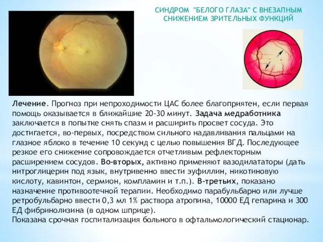 СИНДРОМ "БЕЛОГО ГЛАЗА" С ВНЕЗАПНЫМ СНИЖЕНИЕМ ЗРИТЕЛЬНЫХ ФУНКЦИЙ Лечение. Прогноз при