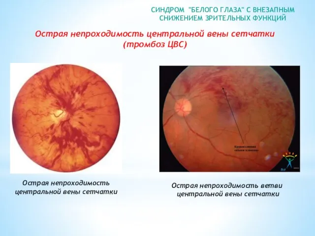 СИНДРОМ "БЕЛОГО ГЛАЗА" С ВНЕЗАПНЫМ СНИЖЕНИЕМ ЗРИТЕЛЬНЫХ ФУНКЦИЙ Острая непроходимость центральной