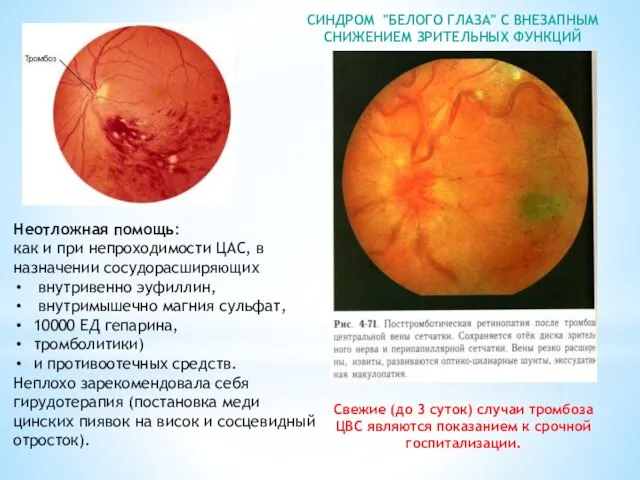 СИНДРОМ "БЕЛОГО ГЛАЗА" С ВНЕЗАПНЫМ СНИЖЕНИЕМ ЗРИТЕЛЬНЫХ ФУНКЦИЙ Неотложная помощь: как