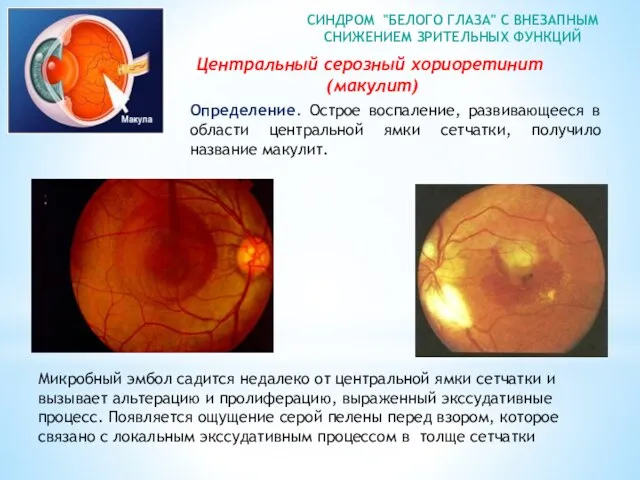 СИНДРОМ "БЕЛОГО ГЛАЗА" С ВНЕЗАПНЫМ СНИЖЕНИЕМ ЗРИТЕЛЬНЫХ ФУНКЦИЙ Центральный серозный хориоретинит