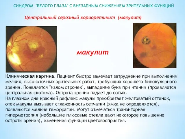 СИНДРОМ "БЕЛОГО ГЛАЗА" С ВНЕЗАПНЫМ СНИЖЕНИЕМ ЗРИТЕЛЬНЫХ ФУНКЦИЙ Клиническая картина. Пациент