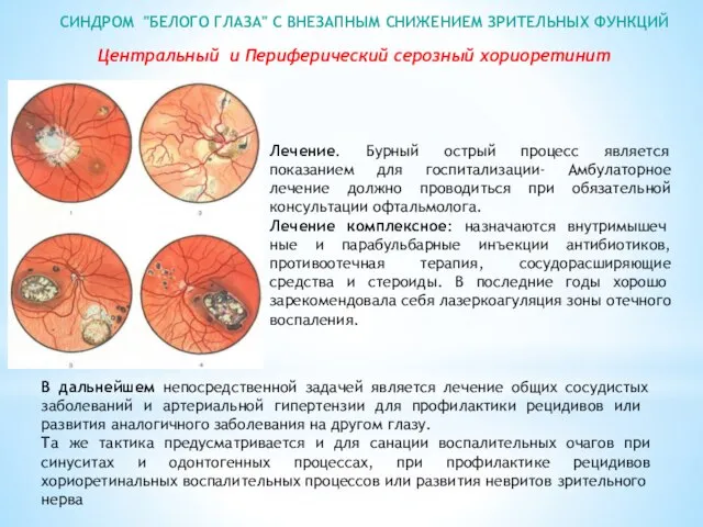 СИНДРОМ "БЕЛОГО ГЛАЗА" С ВНЕЗАПНЫМ СНИЖЕНИЕМ ЗРИТЕЛЬНЫХ ФУНКЦИЙ Лечение. Бурный острый