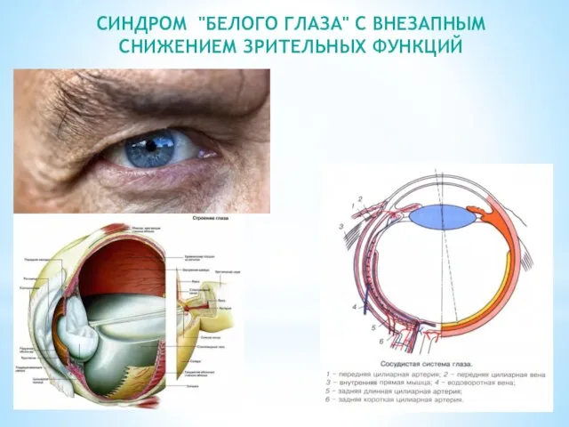 СИНДРОМ "БЕЛОГО ГЛАЗА" С ВНЕЗАПНЫМ СНИЖЕНИЕМ ЗРИТЕЛЬНЫХ ФУНКЦИЙ