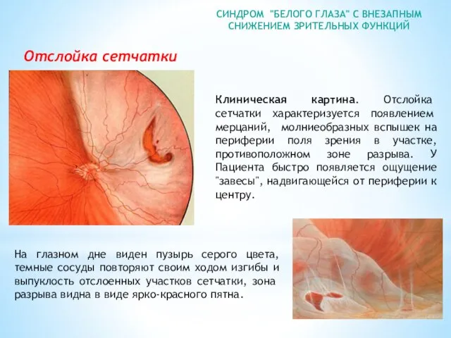 СИНДРОМ "БЕЛОГО ГЛАЗА" С ВНЕЗАПНЫМ СНИЖЕНИЕМ ЗРИТЕЛЬНЫХ ФУНКЦИЙ Отслойка сетчатки Клиническая