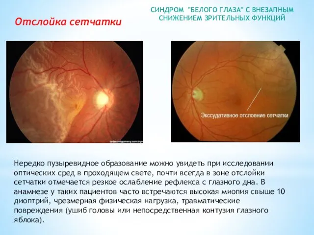 СИНДРОМ "БЕЛОГО ГЛАЗА" С ВНЕЗАПНЫМ СНИЖЕНИЕМ ЗРИТЕЛЬНЫХ ФУНКЦИЙ Нередко пузыревидное образование