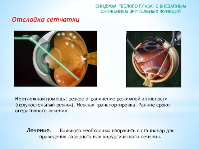 СИНДРОМ "БЕЛОГО ГЛАЗА" С ВНЕЗАПНЫМ СНИЖЕНИЕМ ЗРИТЕЛЬНЫХ ФУНКЦИЙ Лечение. Больного необходимо