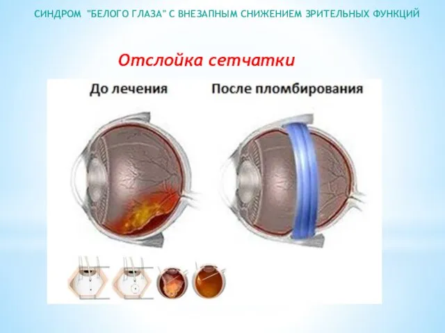 СИНДРОМ "БЕЛОГО ГЛАЗА" С ВНЕЗАПНЫМ СНИЖЕНИЕМ ЗРИТЕЛЬНЫХ ФУНКЦИЙ Отслойка сетчатки